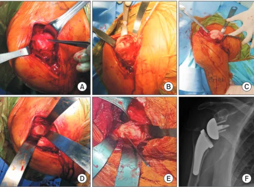 Fig. 1. Representative perioperative images  of the deltopectoral approach to reverse total  shoulder arthroplasty