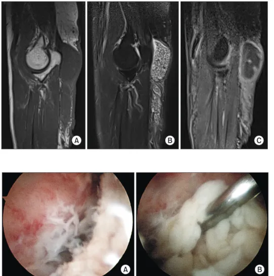 Fig. 4. (A) Inflammatory and proliferated  synovial tissue in the olecranon bursa. (B)  A mass of gray-white colored nodules in the  bursa.