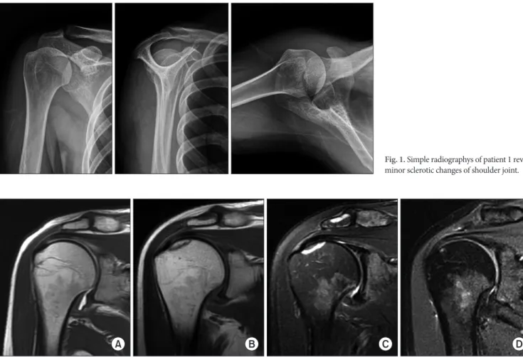 Fig. 2. Serial magnetic resonance (MR) examinations of patient 1 show development and near-complete resolution of focal bone marrow abnormalities after  ultrasound diathermy