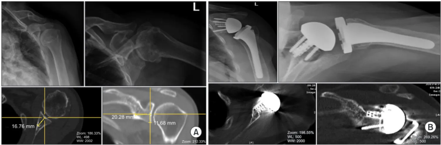 Fig. 5. Group B. In the vault, superior position. (A) Preoperative X-ray and computed tomography (CT) scan
