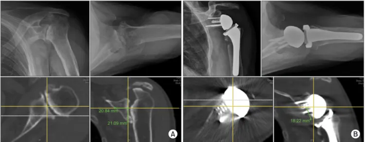 Fig. 6. Group C. In the vault, appropriate position. (A) Preoperative X-ray and computed tomography (CT) scan