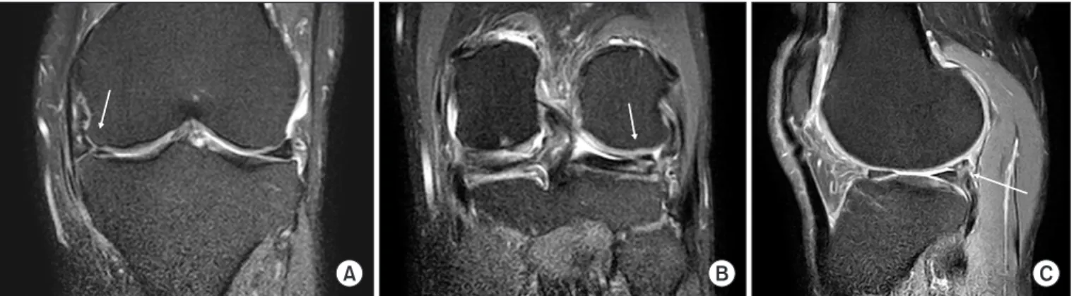 Fig. 2. Arthroscopic views of the left knee show a cord­like structure originating from the posterior horn of the lateral meniscus (A, B) and inserting  into the lateral side of the medial femoral condyle