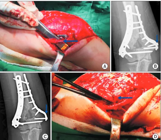 Fig. 1. (A) Soft tissue shield made in the first  surgery disappeared and the ulnar nerve was  in contact with the protruded head of the  second distal screw in the medial plate and  some dark color change (arrow) with a 1mm  diameter was observed on the i