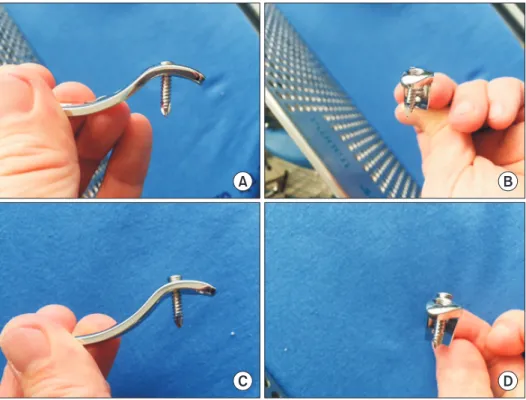 Fig. 2. (A, B) Screw head can be fully seated  if the insertion angle is parallel to the guided  angle of the screw hole