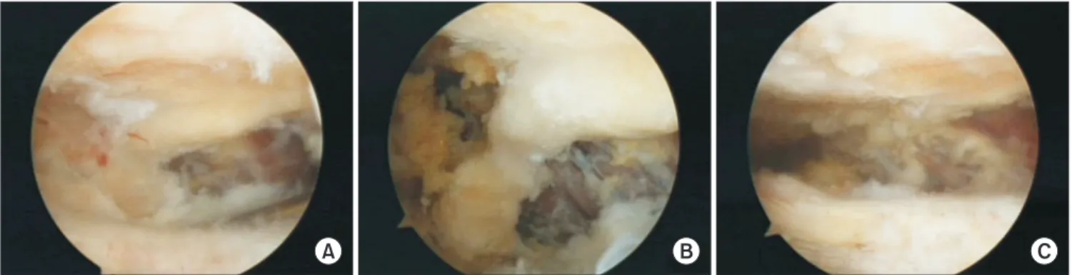 Fig. 3. Arthroscopic excision of the coracoacromial ligament ossification. (A) Coracoacromial ligament ossification is shown in the subacromial space