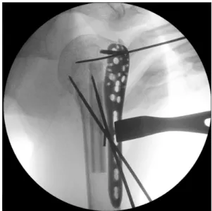 Fig. 1. After temporary fixation with two terminal threaded pins, the locking  plate placement was performed, right shoulder.