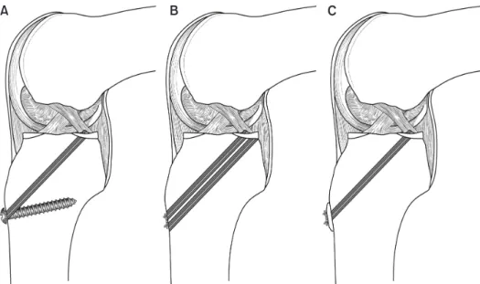 Fig. 4. Fixation technique for the trans- trans-tibial pullout repair: Suture repair is tied  over a screw (A), a button (B), and the  bone bridge (C).