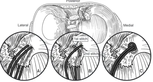 Fig. 5. Illustrations of the stitch configu- configu-rations for the meniscal root repair; (A)  2 simple sutures, (B) modified  Mason-Allen sutures consisting of a horizontal  mattress suture (1st stitch) and a simple  stitch (2nd stitch), and (C) a loop s