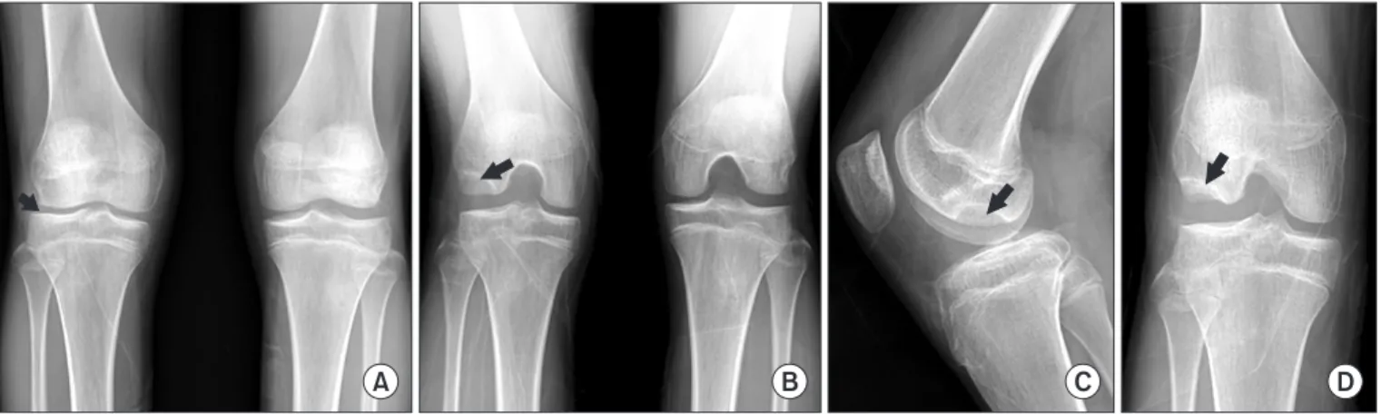 Fig. 2. Standing lower extremity radiograph showing slight valgus of the  right knee (about 2 degrees compared to the left knee).