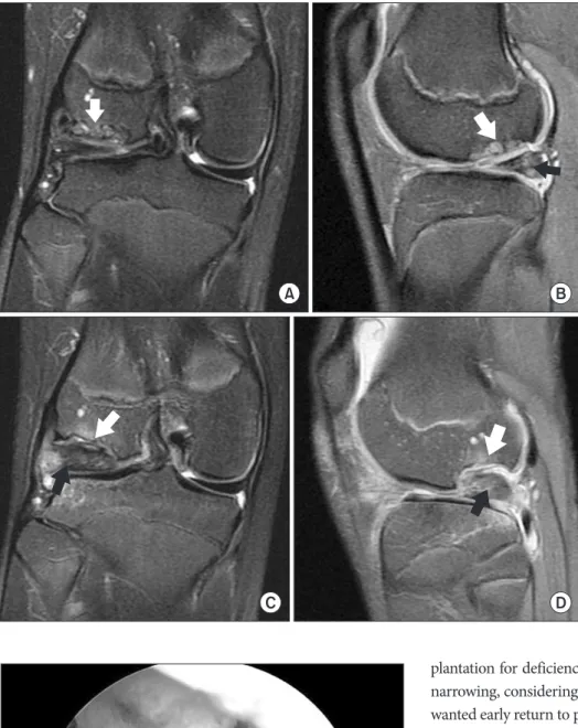Fig. 3. Initial preoperative magnetic reso- reso-nance imaging (MRI) performed at  an-other hospital showing the osteochondral  lesion with subchondral cysts (white arrow)  in the posterior aspect of the right lateral  femoral condyle (LFC) in coronal plan