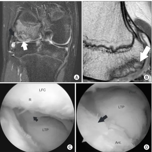 Fig. 8. Follow-up magnetic resonance im- im-aging showed well incorporated periosteal  plug (white arrow) and lateral meniscus  allograft (black arrow) in the posterior  as-pect of the right LFC in coronal plane (A)  and well integrated periosteal plug wit