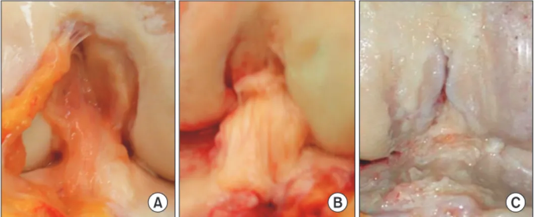 Fig. 2. Posterior tibial slope measurement.