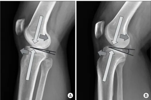 Fig. 3. (A) Relationship between poste- poste-rior tibial slope (PTS) and anteposte-rior tibial  translation