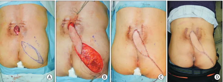 Fig. 1. (A) The preoperative image, superior gluteal artery perforator marking near the defect is shown