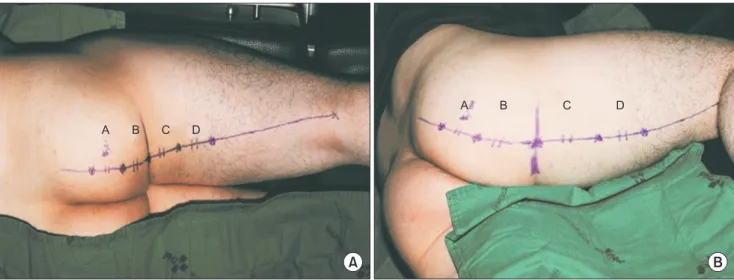 Fig. 1. Design of the 4 divided sections around the ischium. (A) A line was drawn on the gluteal fold while in the neutral prone position