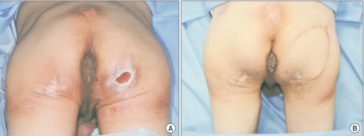 Fig. 3. A case: pre- and postoperative figures. (A) Preoperative ischial pressure sore