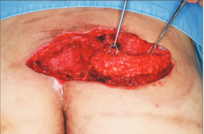 Fig. 4. Adipofascial flap was elevated over the right lateral aspect of  the defect, measuring 8×6 cm.