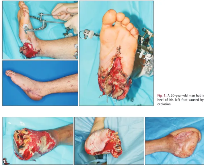 Fig. 2. A 44-year-old man had a soft tissue defect on the dorsum of right foot caused by a traffic accident.