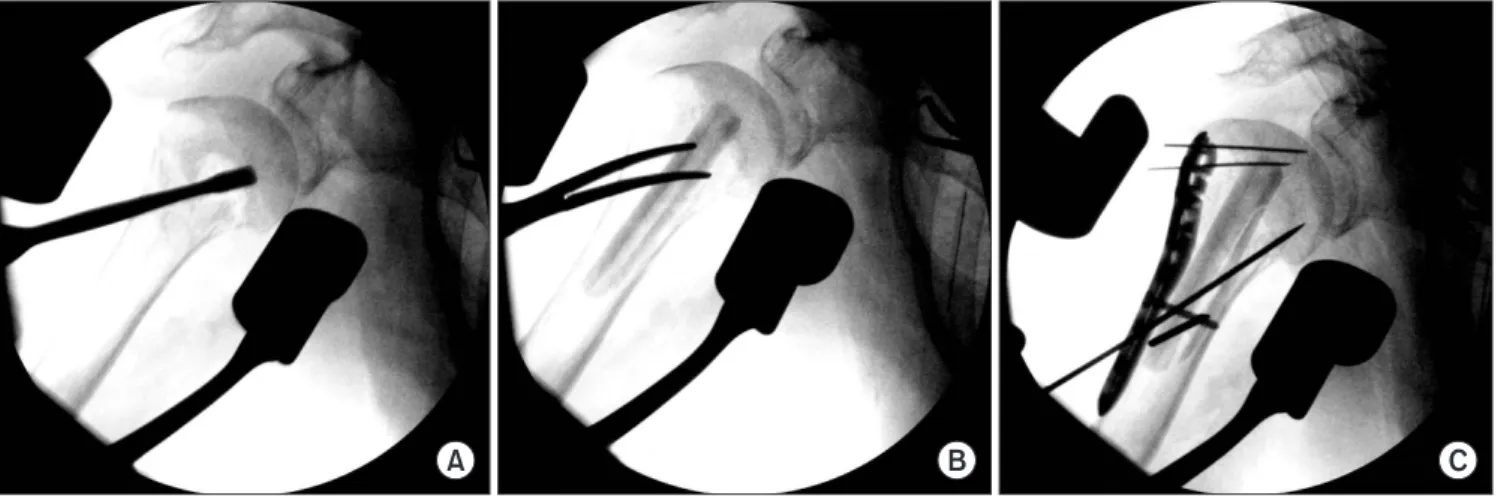 Fig. 5. Image intensification shows the anatomical reduction of the proximal humerus fracture (A); the inserted fibular allograft (B); and the anatomical plate fix- fix-ated using a screw (C).
