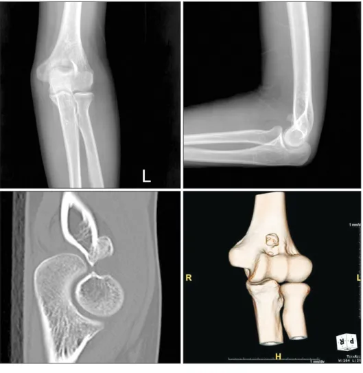Fig. 1. Simple radiography and 3-dimensional  computed tomography shows benign tumor  involving the distal humerus with a stalk