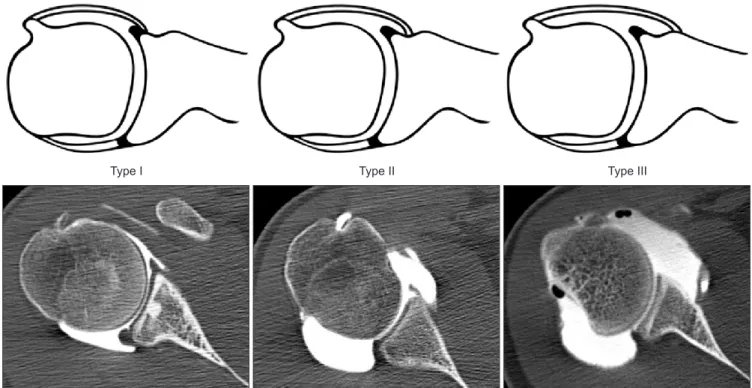 Fig. 1. An illustration of the anatomical variations of anterior capsular attachment and their corresponding computed tomography images from patients with an- an-terior shoulder instability