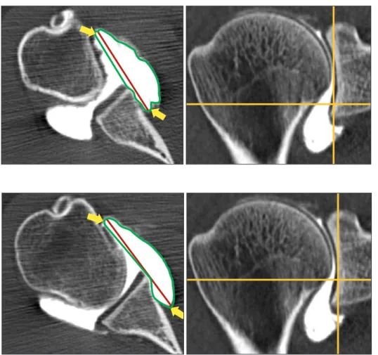 Fig. 2. Capsule at the 5 o’clock position. Axial  computed tomography slices at the level that  is 6 mm superior to the inferior margin of  the glenoid