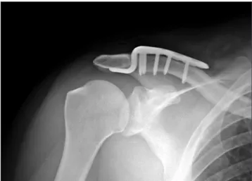 Fig. 1. Trans-acromial fixation with Kirschner’s wires, right shoulder. Fig. 2. Locking hook plate fixation, right shoulder.