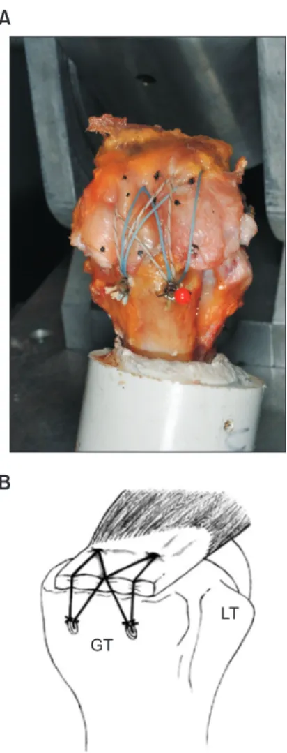 Fig. 6. Th   e construct of the transosseous-equivalent suture bridge technique  (A) and the schematic diagram (B)