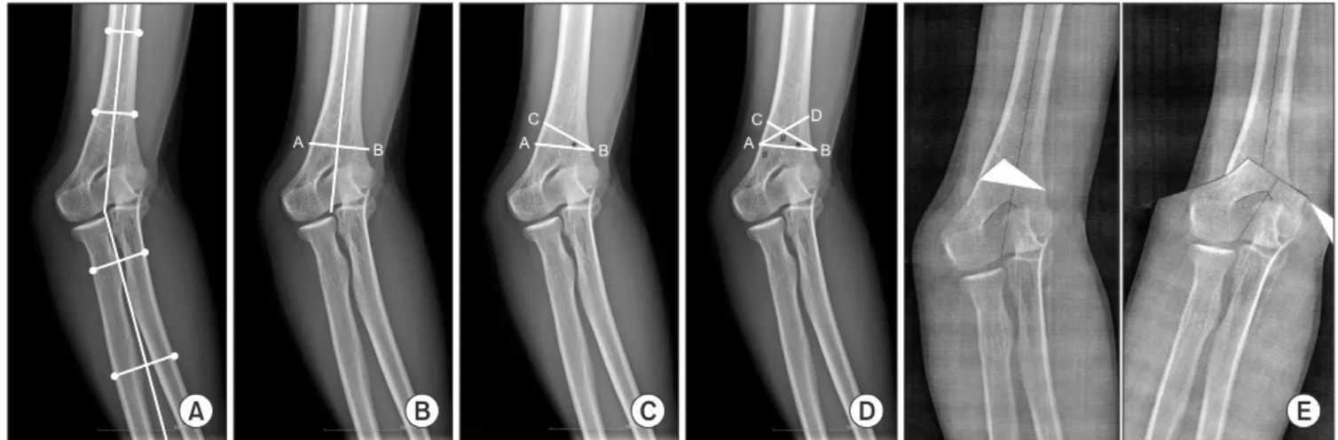 Fig. 3. (A) Desired triangle was removed  after osteotomy. (B) Reduction of the  oste-otomized fragement and temporary fi xation  with K-wire