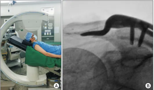 Fig. 1. Hook view. (A) Subject positioning for  the fluoroscopic hook view. (B) Hook view  can show the optimal contact of the hook  plate.