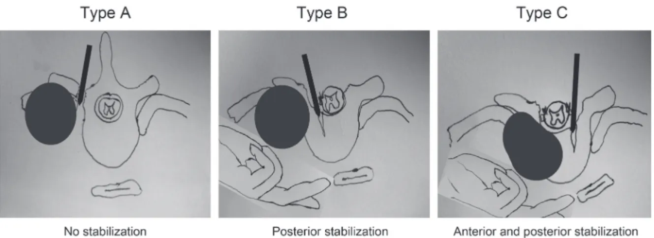 Fig. 1. Preoperative evaluation of a patient with a type-C tumor (patient  no. 1). The computed tomography scan in sagittal (A), coronal (B),  and axial plan (C) reveals the tumor and spinal involvement