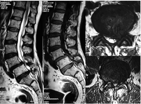 Fig. 4. Postoperative X-ray of Case no. 2 showing posterior instru- instru-mentation with transforaminal lumbar interbody fusion cage at  L4–5.