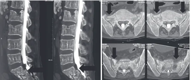 Fig. 6. Intraoperative image of case 3 showing the position of needles in the mediolateral and craniocaudal  directions.