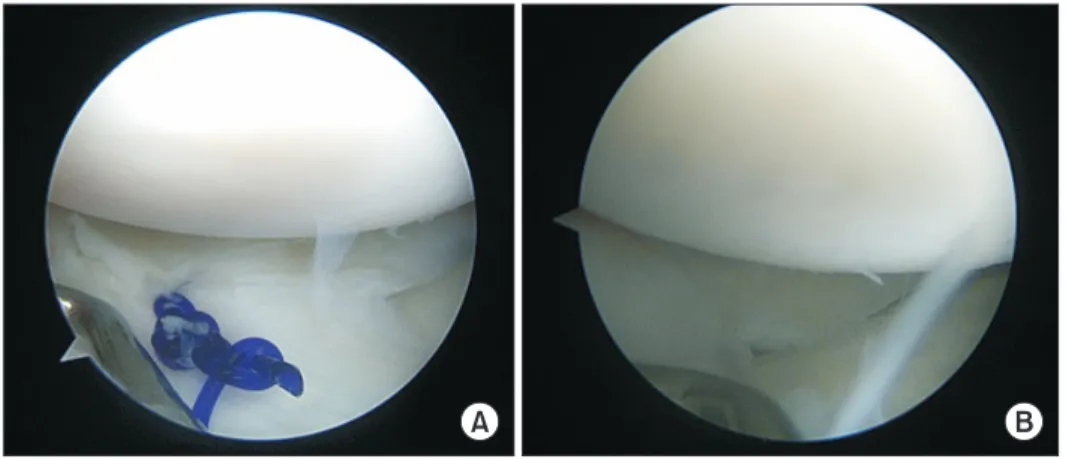 Fig. 3. (A) An arthroscopic view of the  ends of the PDS suture tied as a vertical  SMC knot tie, which exert adequate  ten-sion on the reduced meniscus