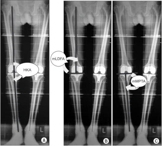 Fig. 3. Postoperative radiographic mea- mea-surements in the right limb. (A)  Hip-knee-ankle angle (HKA)