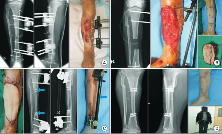 Fig. 1. Traditional free vascularized fibular graft (VFG) with minimal internal fixation