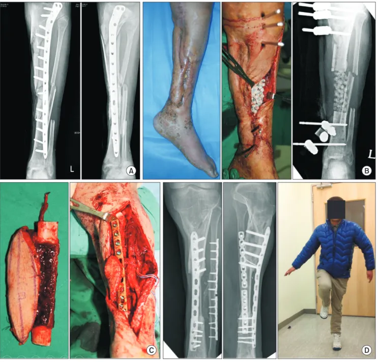 Fig. 2. Bridging locking plate fixation for vascularized fibular graft (VFG). (A) Chronic osteomyelitis of tibia with soft tissue defect in 38-year-old man