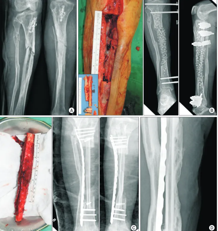 Fig. 3. Cancellous bone graft augmentation with vascularized fibular graft (VFG). (A) Chronic osteomyelitis of tibia with pathologic fracture in 55-year-old  man