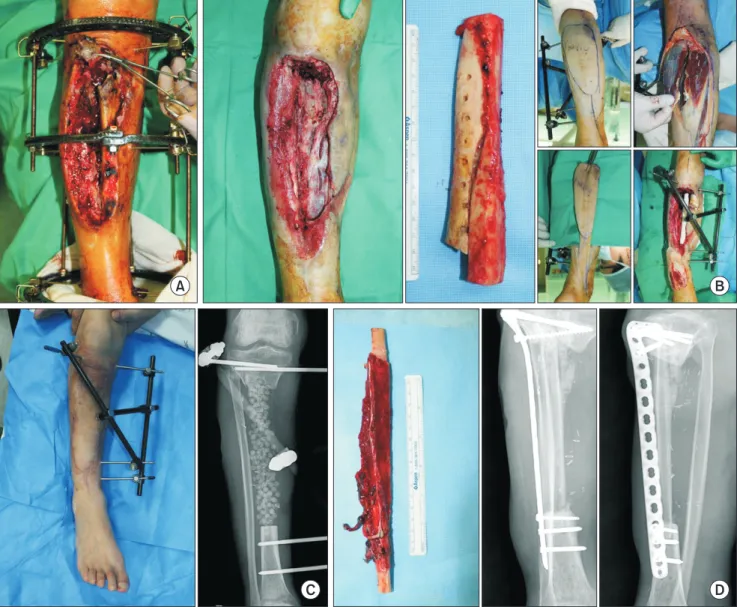 Fig. 4. Staged reconstruction for huge bone and soft tissue defect. (A) Huge soft tissue and bone defect which can’t be reconstructed by the one- one-stage free vascularized osteocutaneous flap in 54-year-old man