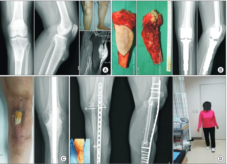 Fig. 5. Knee joint arthrodesis using a double-strut vascularized fibular graft (VFG). (A) Osteosarcoma in proximal tibia in 60-year-old woman