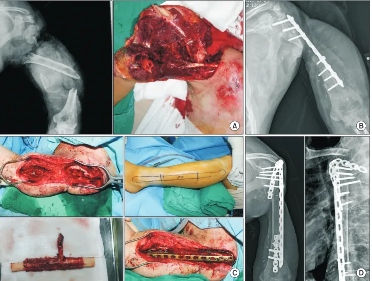 Fig. 6. Shoulder joint arthrodesis using a vascularized fibular graft (VFG). (A) Near total amputation of arm and shoulder in 42-year-old man