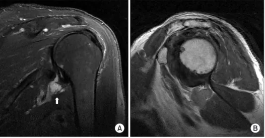 Fig. 3. Postoperative proton density-weighted coronal oblique image reveals  complete resolution of the cyst.