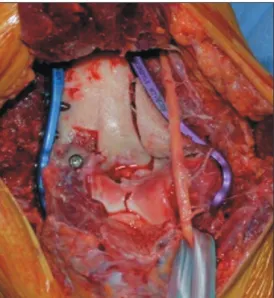 Fig. 1. Intraoperative view of fixation using orthogonal plating. Note that the 