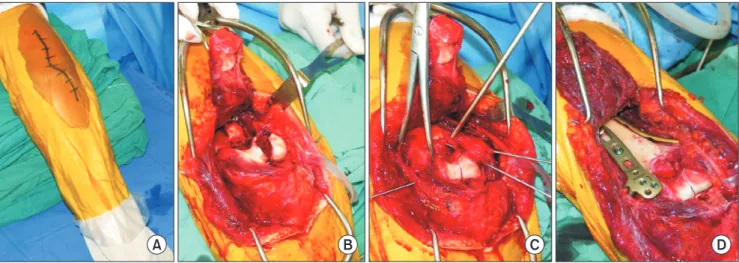 Fig. 4. Postoperative radiographs demonstrating fixation using orthogonal  plating.