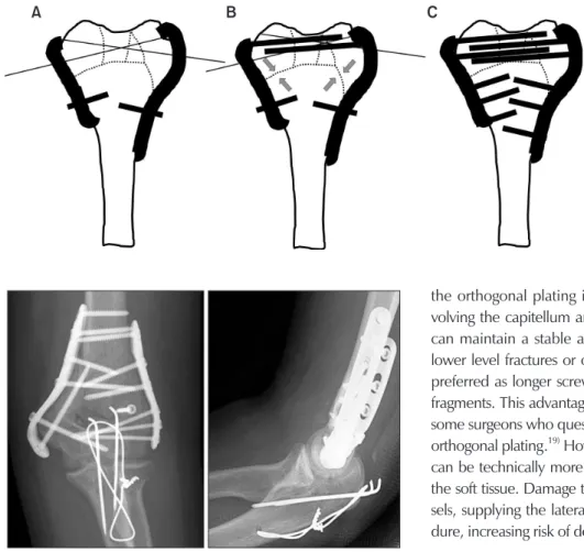 Fig. 5. Surgical techniques of parallel plating. 