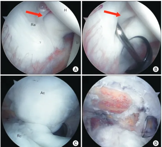 Fig. 3. (A) Arthroscopic image of the right  shoulder showing the intra-articular site of  the rotator cuff tear (arrow) from the  pos-terior viewing portal with the patient in the  lateral decubitus position