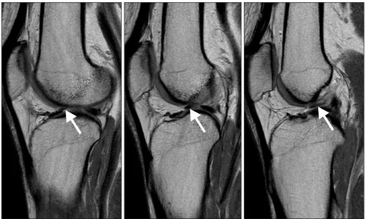 AOSM Anterolateral meniscofemoral ligament with congenital aplasia of ...