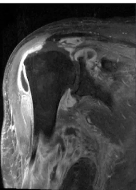 Fig. 2. A magnetic resonance imaging before the second operation shows  multiple pus pockets in the proximal humerus.