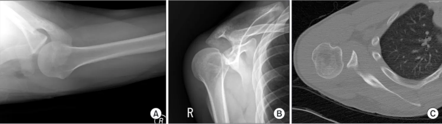 Fig. 1. (A, B) X-ray showing bone defect of the posterior glenoid cavity &amp; posterior dislocation of the shoulder joint