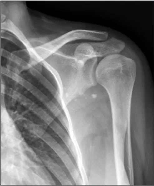 Fig. 1. Simple radiograph of left shoulder showing multiple small round calci- calci-fications in the front of the scapular neck.